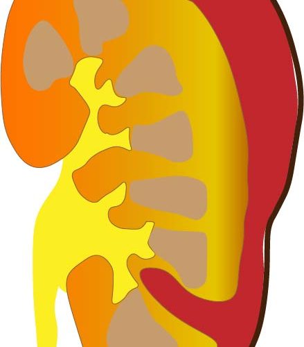 Trauma: Right kidney laceration