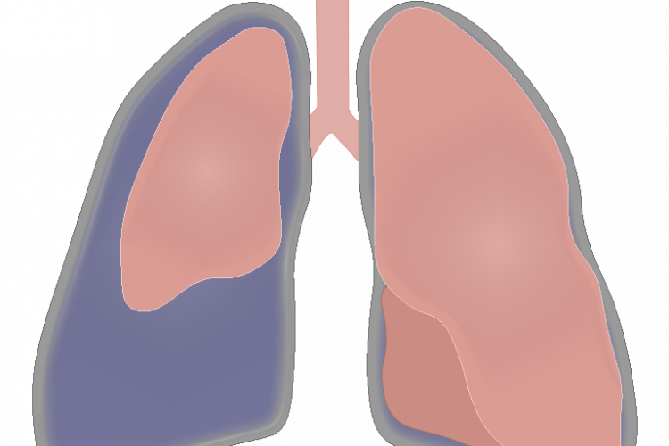 Pneumothorax : Test yourself