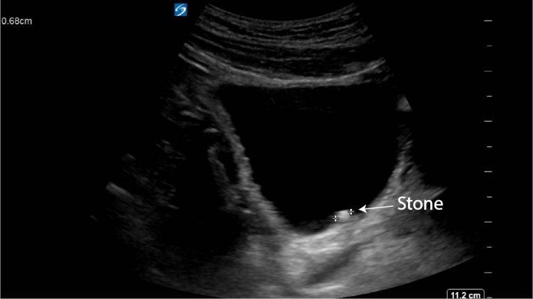 Renal stones in PUJ - Critical Care Sonography