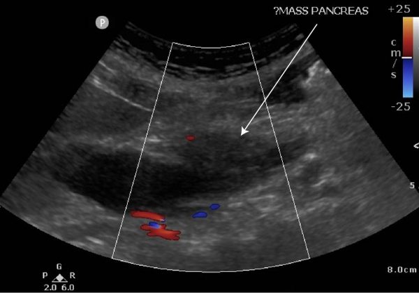 Dilated CBD, pancreatic carcinoma - Critical Care Sonography