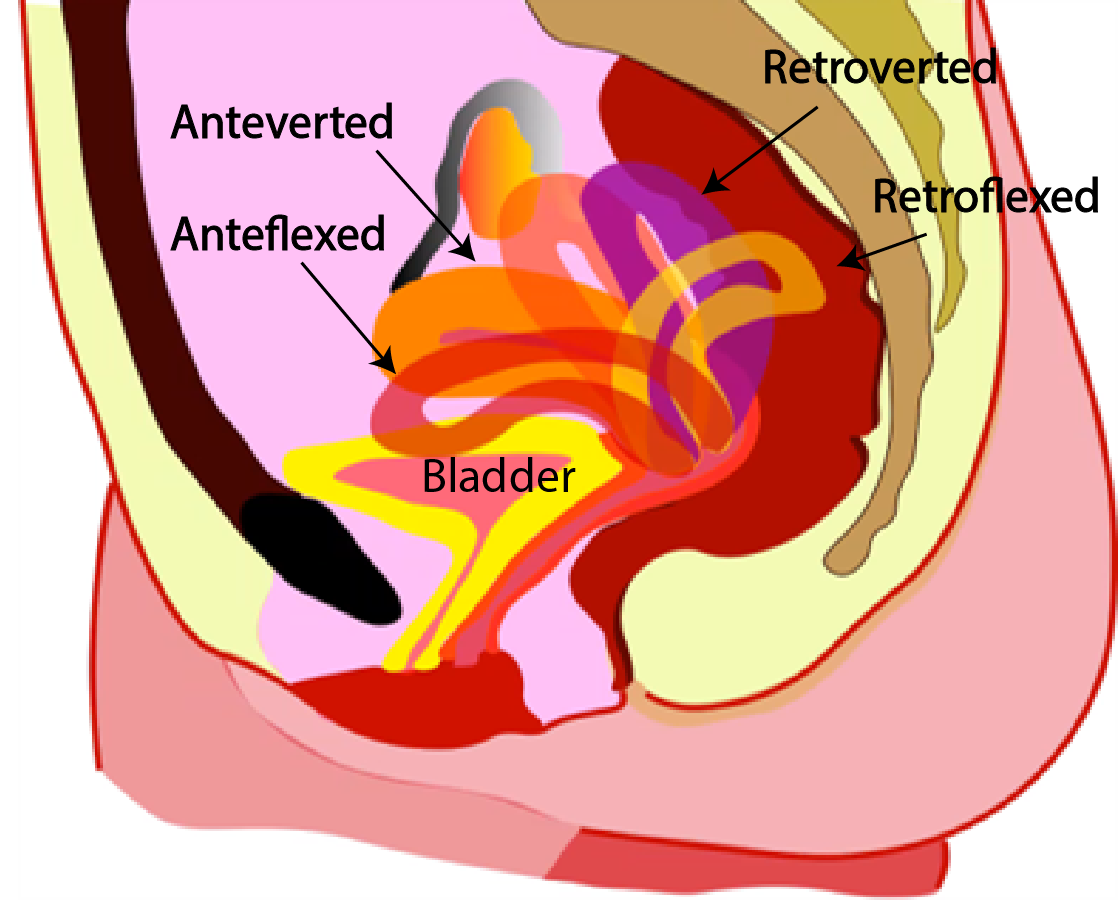 Retroverted Uterus Nhs 8726